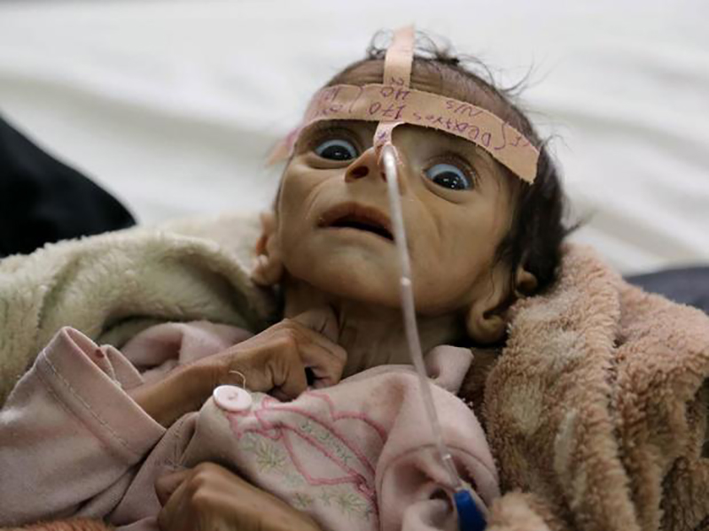 Yemen: la tragedia dei bambini.