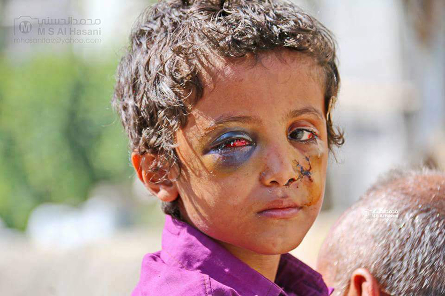 Yemen: la tragedia dei bambini.