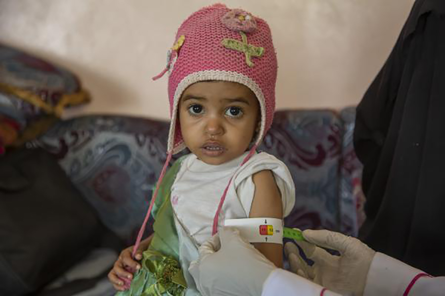Yemen: la tragedia dei bambini.